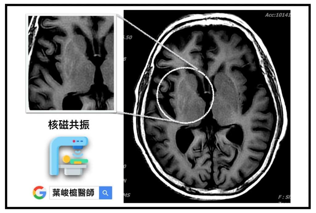 Non-ketotic Hyperglycemia induced Hemiballism Hemichorea