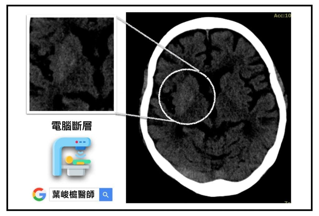Non-ketotic Hyperglycemia induced Hemiballism Hemichorea