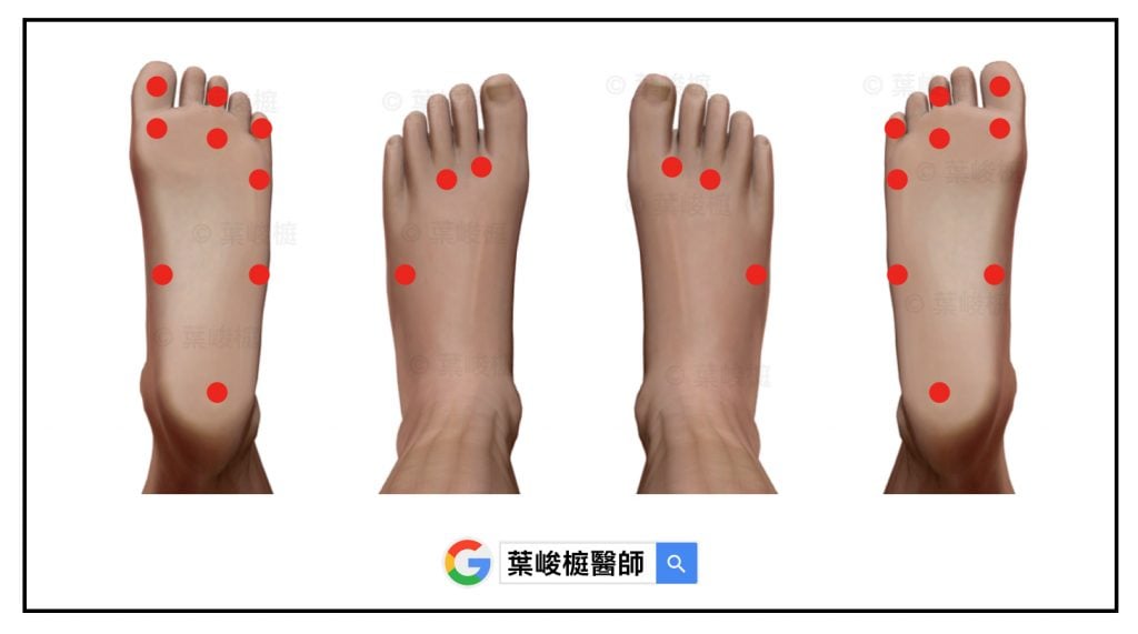 糖尿病周邊神經病變